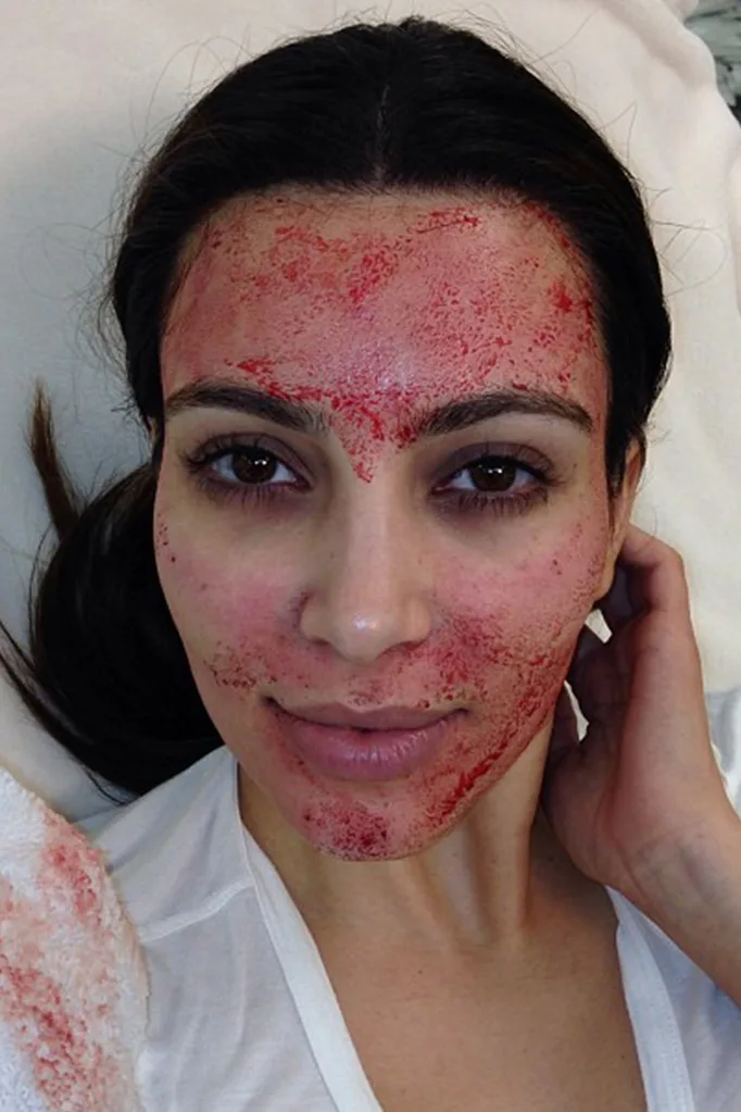 kim-kardashian-having-a-vampire-facial