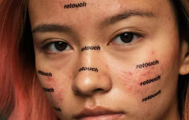 This Student Photographer’s Instagram Is Changing How We See Acne On Social Media