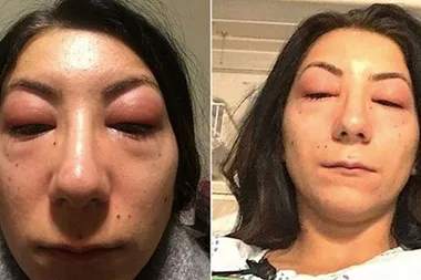 The Popular Beauty Treatment That Left This Woman’s Eyes Swollen Shut