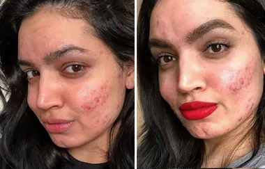 Huge beauty company forced to apologise to beauty blogger for her acne
