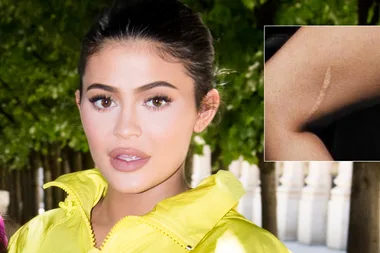 The truth about Kylie Jenner’s massive leg scar