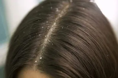 Dandruff scraping is the new gross beauty trend you need to see