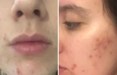 ‘The miracle solution that cleared my adult acne’