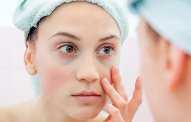 What causes dark circles under eyes?