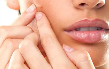 There Will Soon Be A Vaccine Available For Acne And FINALLY!