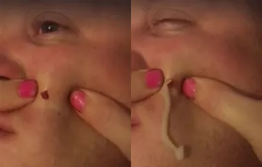 This Video Of A 4-Year-Old Blackhead Being Squeezed Is Horrifying Yet Mesmerising