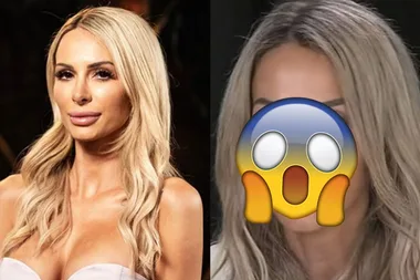 MAFS Stacey dissolves her lip fillers and looks unrecongisable