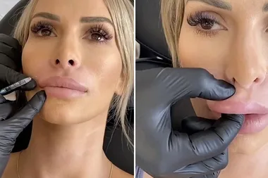 MAFS Stacey removes her lip fillers for good and she looks FIRE