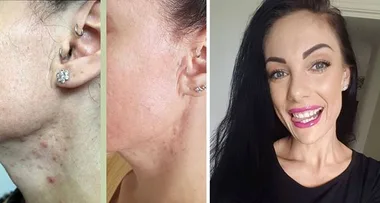 MAFS Vanessa reveals how she cured her extreme acne