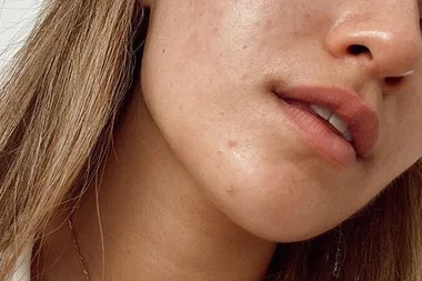 An Expert Explains Why You’re Getting Acne On Your Chin