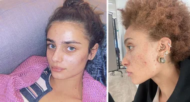 Easy Pimple Vanishing Treatments To Help You Beat A Breakout