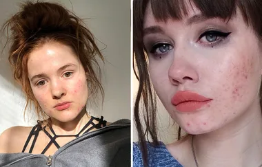 The New Acne Trend On Instagram Is Everything We’ve Been Waiting For