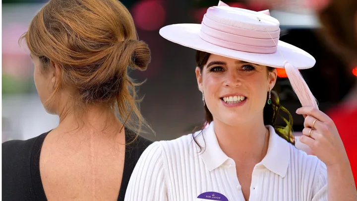 princess eugenie scoliosis scar