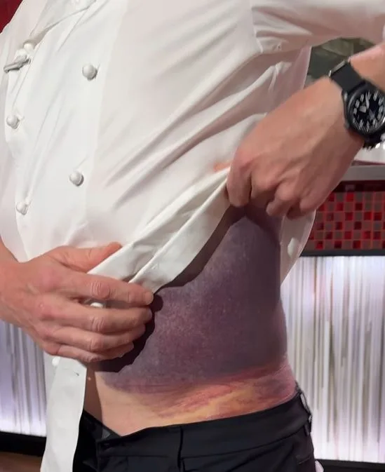 gordon ramsay's bruise from bike accident