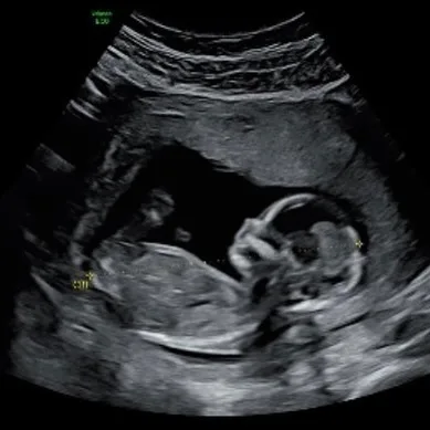 john pearce baby ultrasound