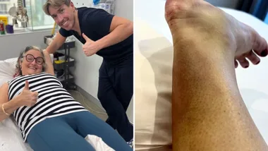 Two people giving thumbs up in a medical setting; a close-up of a swollen ankle on the right.