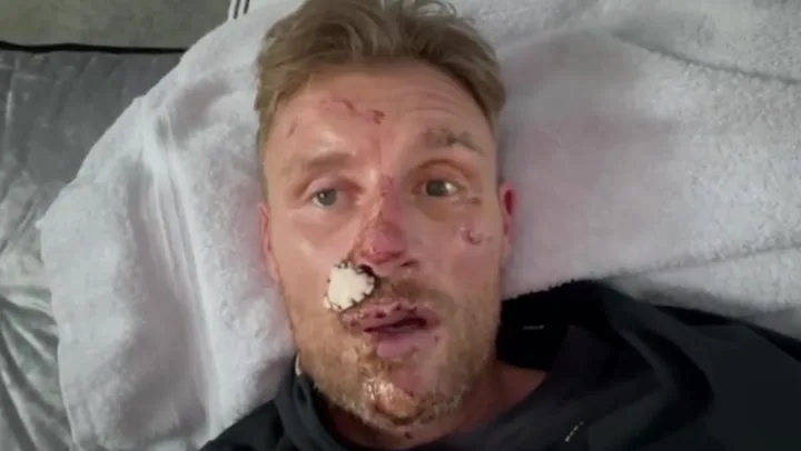 Freddie Flintoff facial injuries