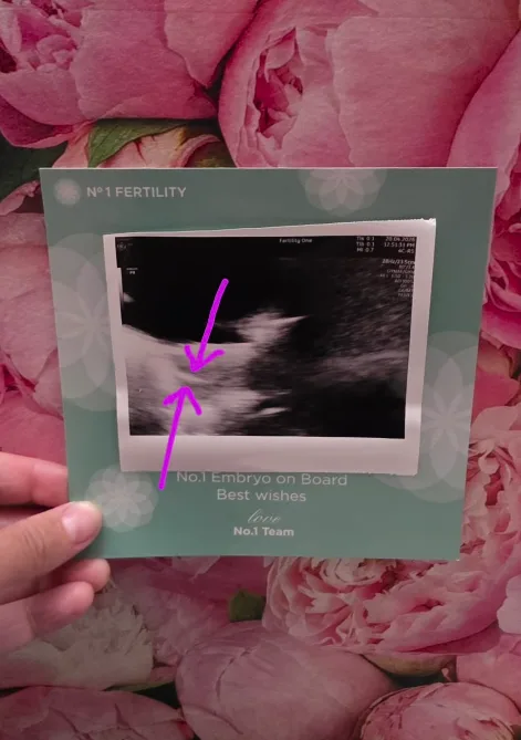 Casey Donovan IVF embryo transfer