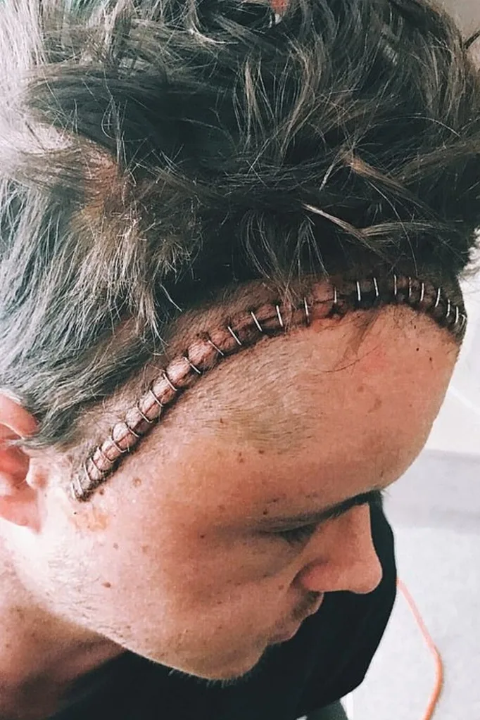 Johnny Ruffo brain stitches