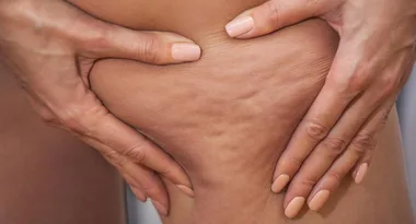 The expert-approved ways to reduce cellulite -including an affordable cream reviewers swear by