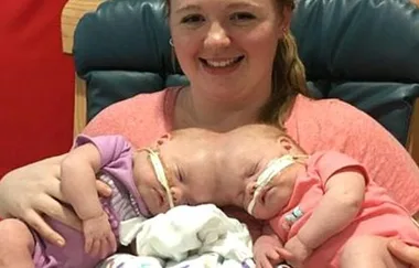 10-month-old conjoined twins are successfully separated