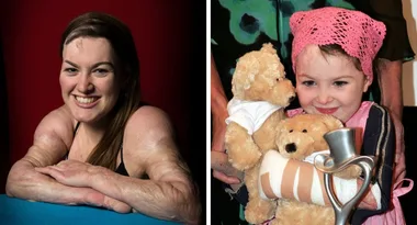 Burns victim Sophie Delezio doesn’t let anything stand in the way of her happiness