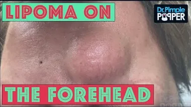 The extreme ‘pimple popping’ video that shocked the Internet