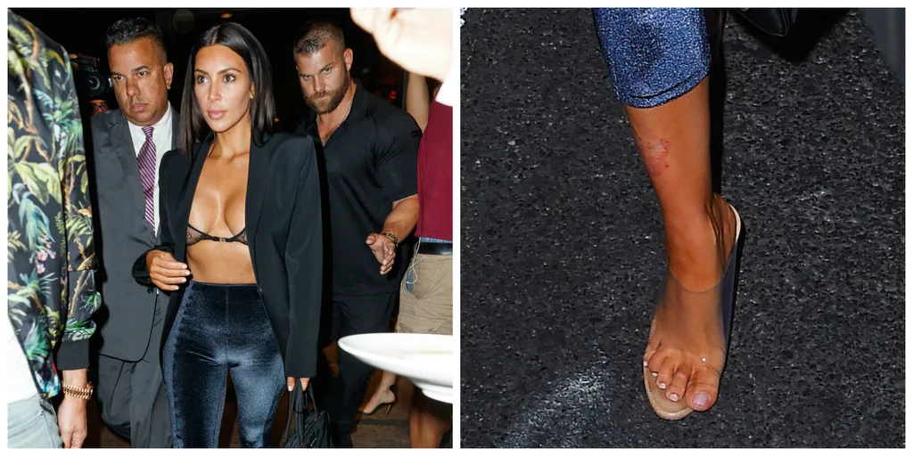 Kim Kardashian Psoriasis