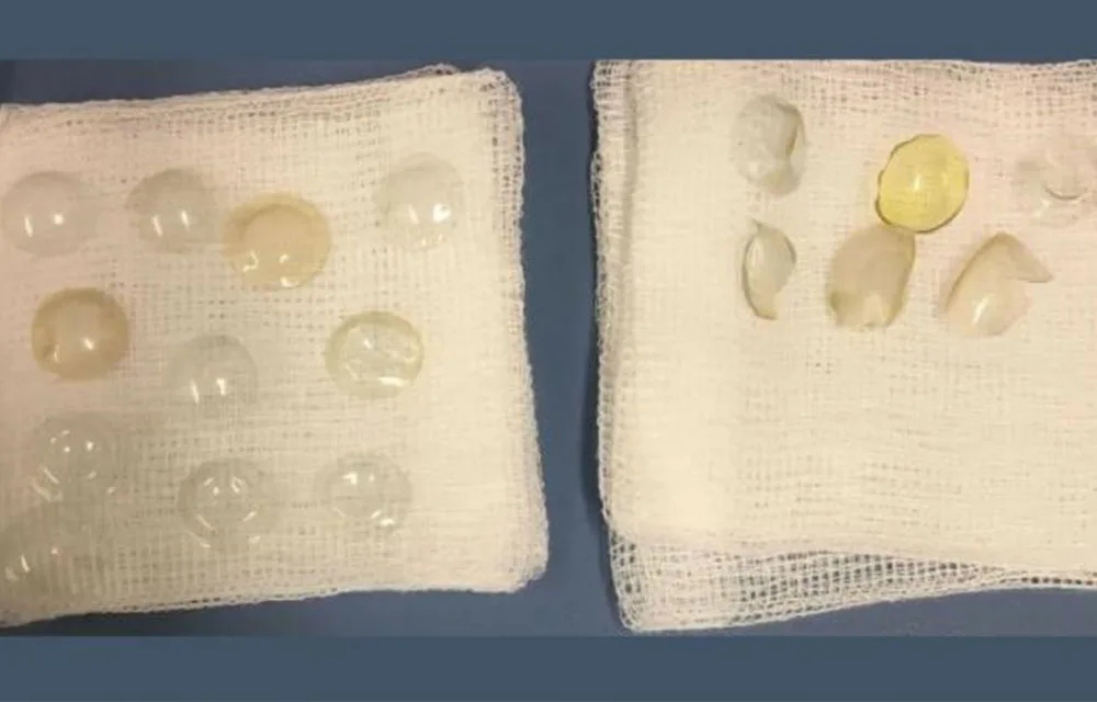 Contact lenses