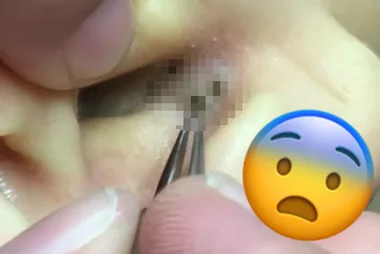 Massive blackheads dragged from ear are sickeningly mesmerising