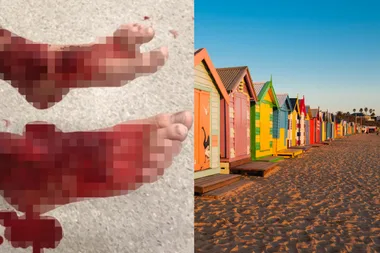 Mystery sea bugs shred Melbourne teen’s legs