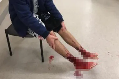 Mystery solved: Melb teen’s bloodied feet were the victim of this terrifying creature