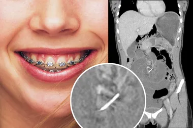 You won’t believe what surgeons found in this 30yo woman’s guts