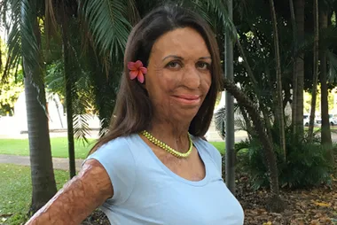 Turia Pitt shares pregnant selfie in a bikini
