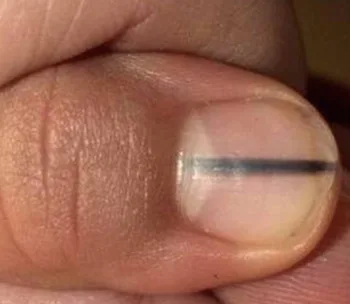 Dark stripe on woman’s nail turns out to be deadly disease
