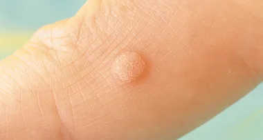 11 effective natural ways to get rid of irritating warts