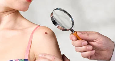 The must-know update on how to detect melanomas