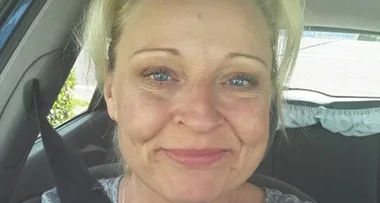 ‘My face was eaten alive’