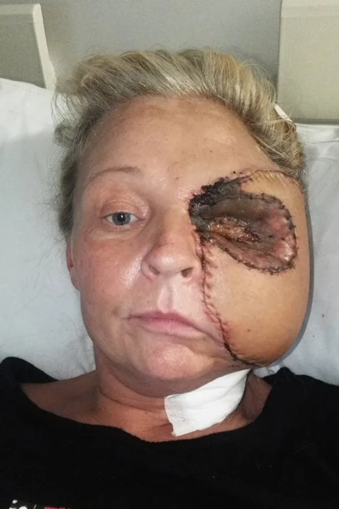 donna after skin graft