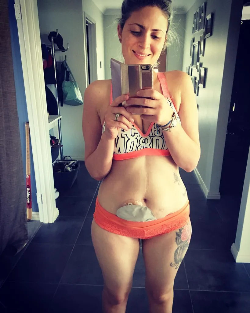 Krystal Miller has spoken candidly about her battle with Crohn's disease