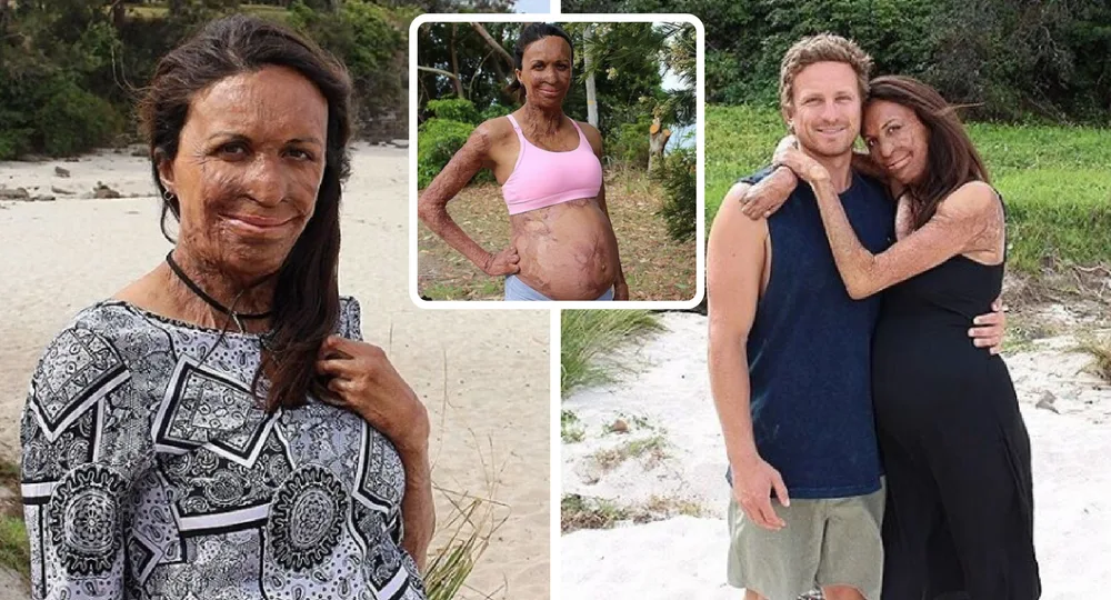 Burns survivor Turia Pitt reveals why she won't talk about the fire that changed  her life | New Idea
