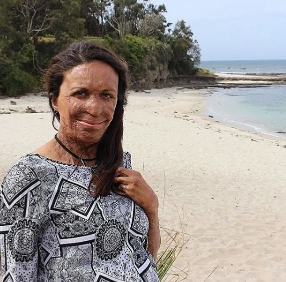 Burns survivor Turia Pitt has opened up about her nerves as her baby boy's birth is imminent