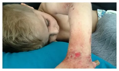 8-year-old’s eczema was so bad his mother claims ‘he didn’t want to be here anymore’
