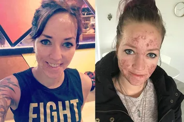 Woman with severe acne reveals how the agonizing condition left her too scared to go outside