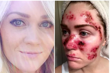This woman’s shocking selfie of her skin cancer treatment has saved lives