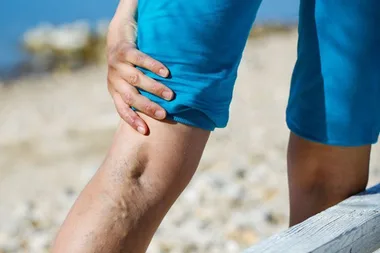 Five home remedies for varicose veins