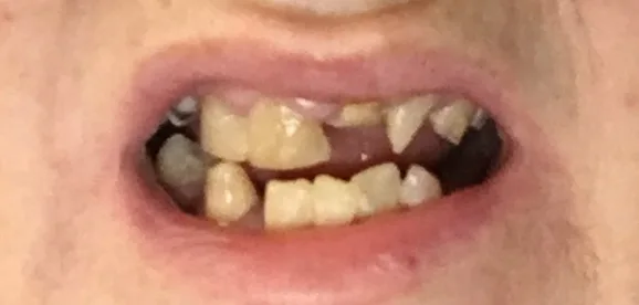 teeth damage