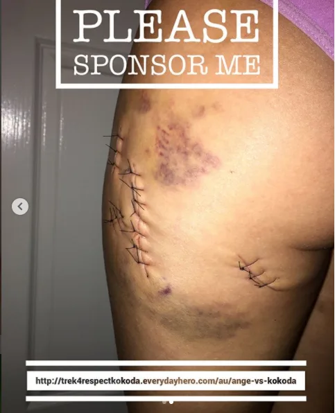 Woman stabbed by Tinder date shares shock pics of her scars