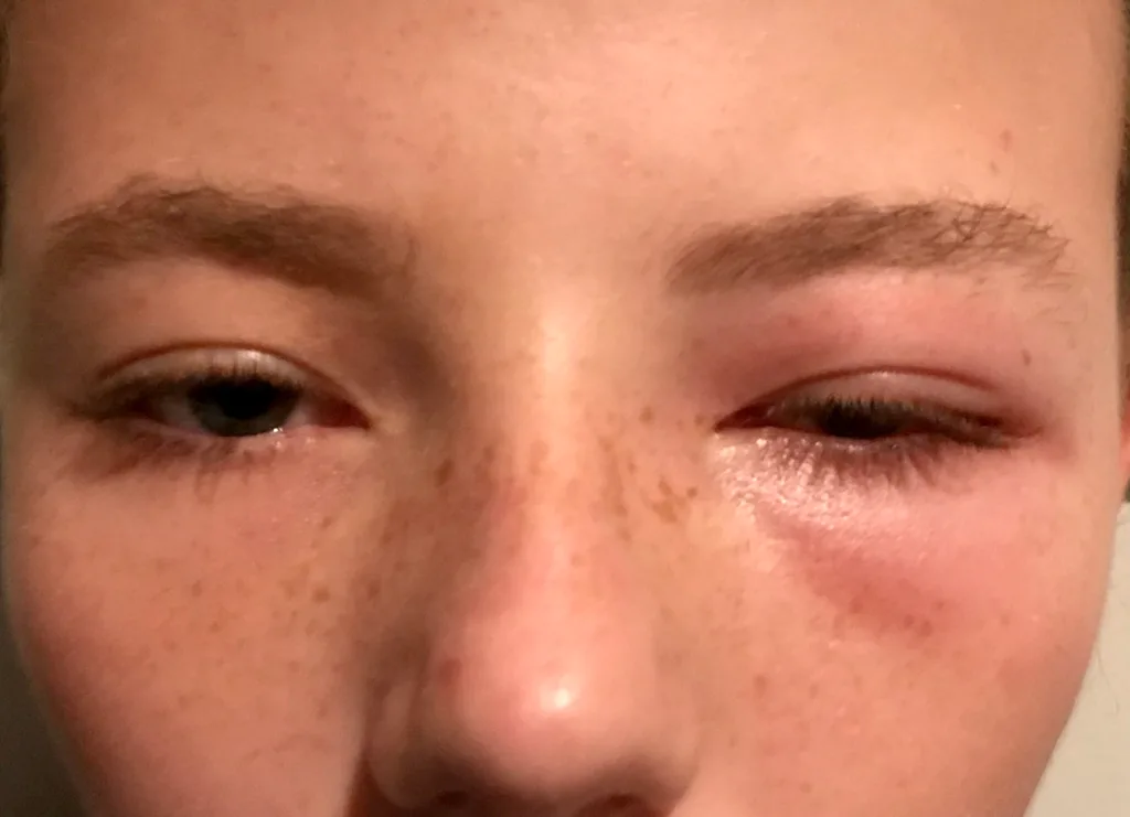 14-year-old &lsquo;blinded&rsquo; by $3 Kmart eye mask