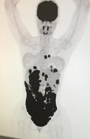 24-year-old tells: ‘My mystery pain was cancer’